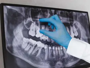What did the dentist call the x-ray he took of your mouth?